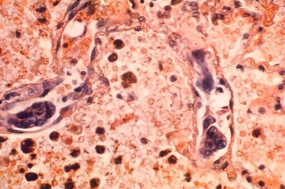 Another Record Decline Reported In US Cancer Death Rate