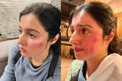 Divya Khosla Kumar Gets Injured While Shooting Action Sequence, Shares Pic of Bruised Face
