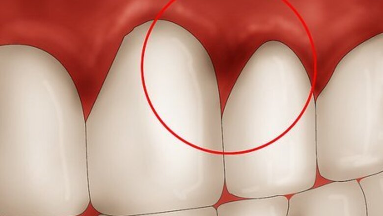 How to Get Rid of Gingivitis