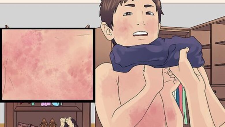 How to Recognize and Treat Scarlet Fever