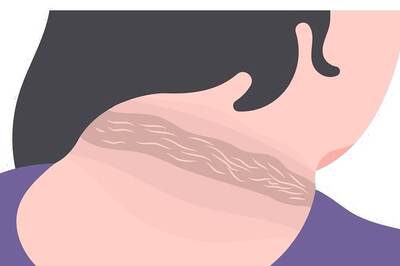 Combating Pre-Diabetic Pigmentation: Unveiling Treatment Options