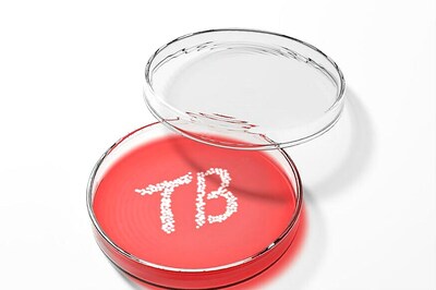 New Blood Test Identifies TB Infections Within Hours
