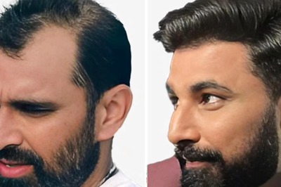 Boney Kapoor to Mohammed Shami: Meet the Doctor Behind Successful Celebrity Hair Transplants