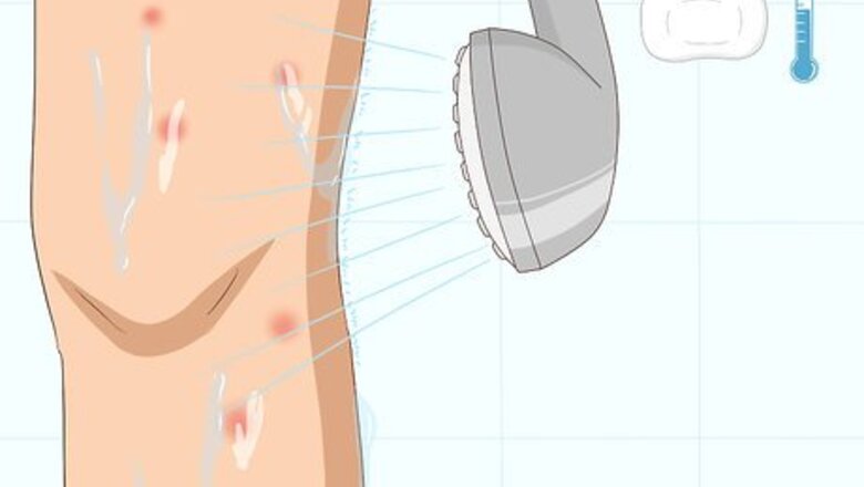 How to Treat Mosquito Bites Quickly at Home