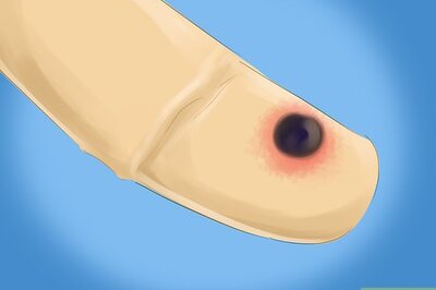 How to Pop a Blood Blister