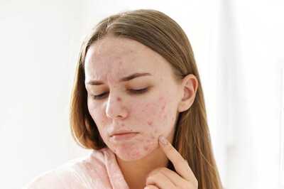 Are You Dealing With Acne? Here Are 4 Skin Tips for Clear And Smooth Skin