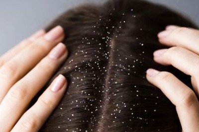 Watch: Ayurveda Expert Shares Easy DIY Anti-dandruff Mask