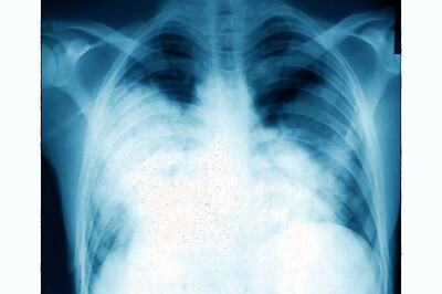 Pneumonia Decreases By 35% in Children: Study