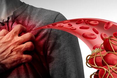 Abnormal Antibody Response Causes Blood Clots in People with Severe Covid-19 Infection, Says Study