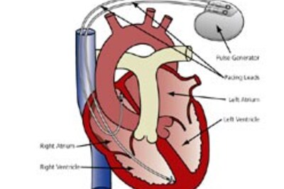 Pacemaker gets an Indian helping hand