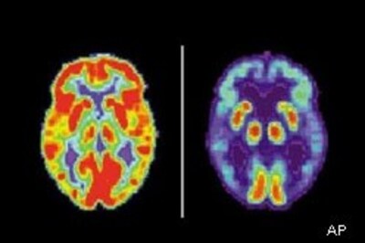 Possible fingerprint of Alzheimer's found