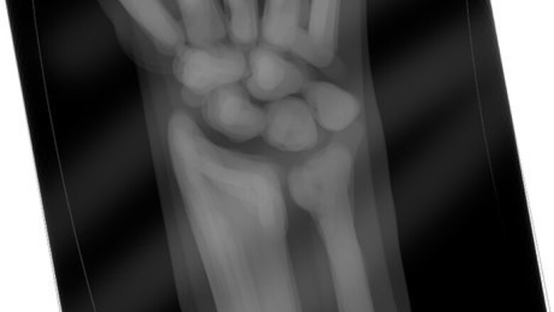 How to Prevent Thyroid Cancer