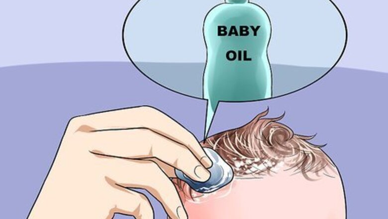 How to Easily Clean Baby's Cradle Cap Dandruff Without Hurting the Baby