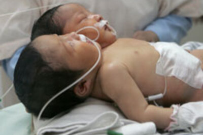 Conjoined twins born in Indonesia