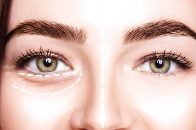 These are the Factors Causing Dark Circles and Here's How You Can Treat Them