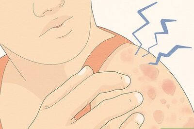 How to Recognize Hives (Rash)