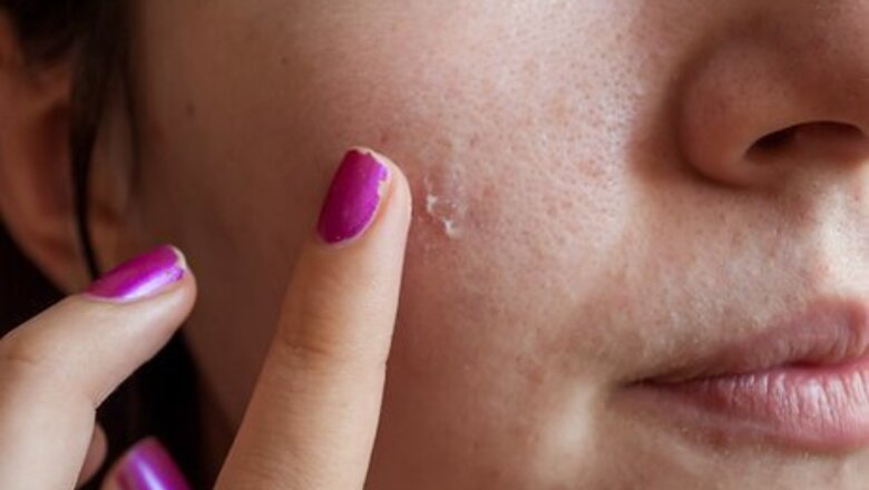 How to Use Green Eyeshadow to Cover a Red Pimple