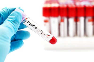 Mumbai Sees Seven New Measles Cases, One Suspected Death