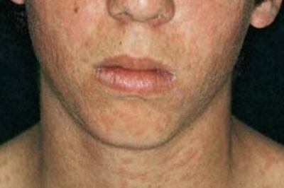 Govt campaigns for measles vaccination