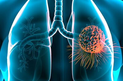 Lung Cancer: Symptoms, Myths and Treatment