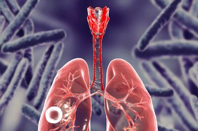 Stem Cells May Help In Treatment of Tuberculosis, But Challenges Remain: Study