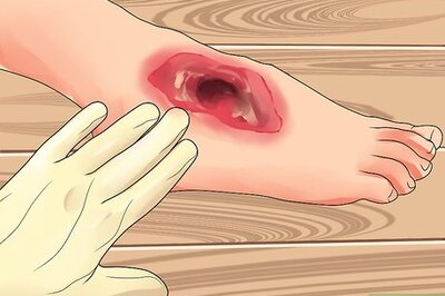How to Measure Wound Granulation