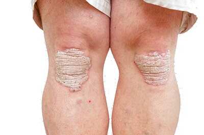 New Vaccine Hope For Psoriasis Patients