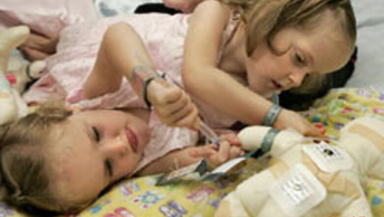 Conjoined twins separated successfully