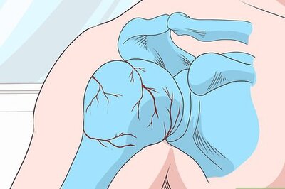 How to Splint a Humerus Fracture