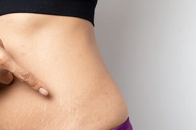 Why Stretch Marks are Caused and Effective Ways To Get Rid Of Them