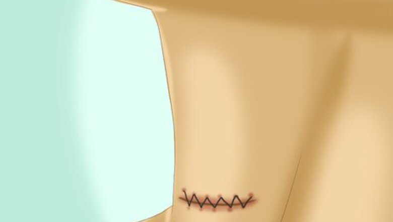 How to Take Care of an Incision After Thyroid Surgery