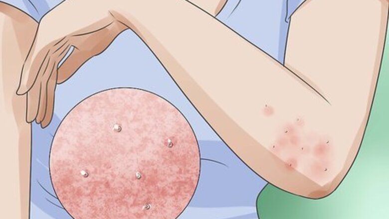 How to Recognize Morgellons Symptoms