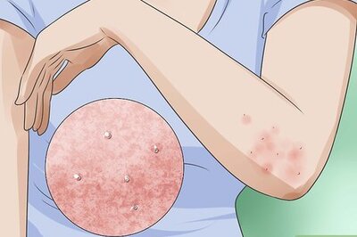 How to Recognize Morgellons Symptoms