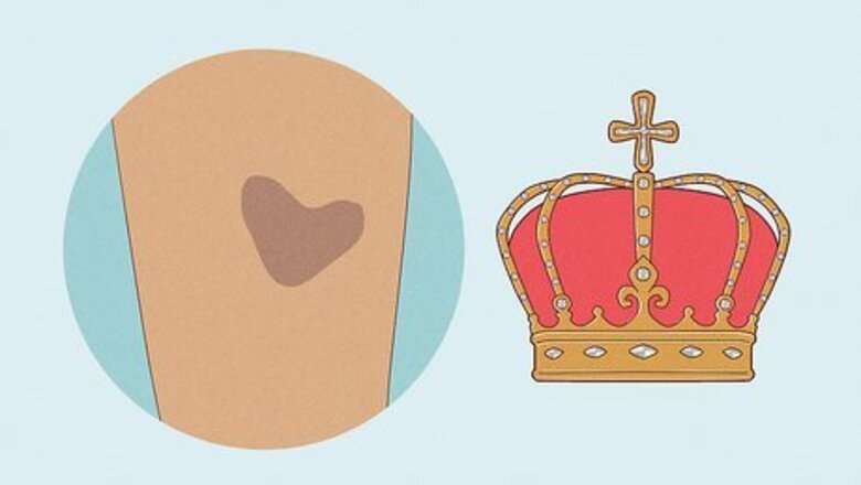 Everything You Need to Know About Royal Birthmarks