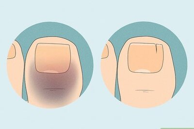 How to Treat a Stubbed Toe