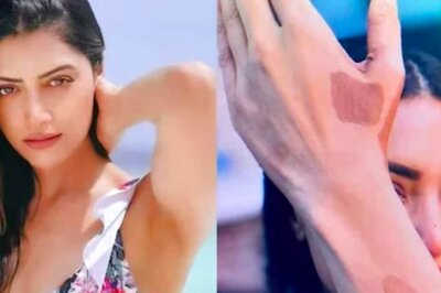 Understanding Vitiligo: Insights from Experts