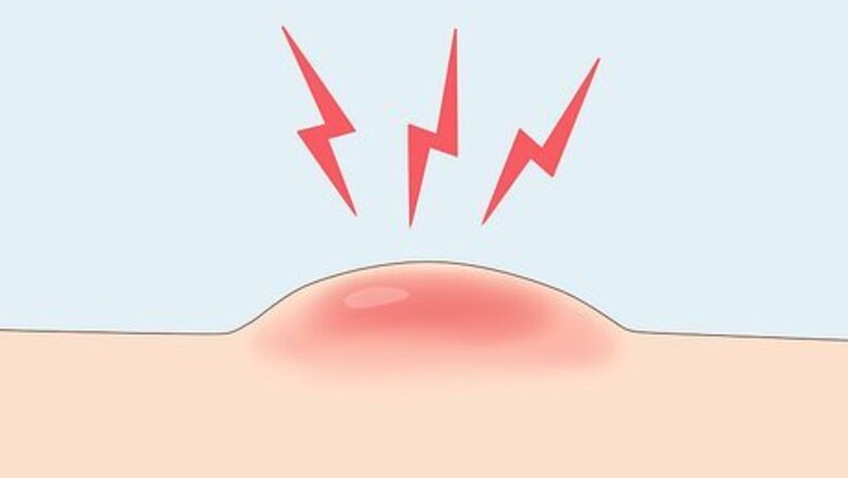 How to Prevent Cystic Acne