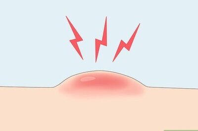 How to Prevent Cystic Acne