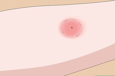 How to Treat Spider Bites on Kids