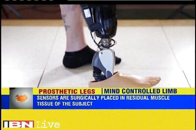 New sensors allow people to control limbs with their minds in Iceland