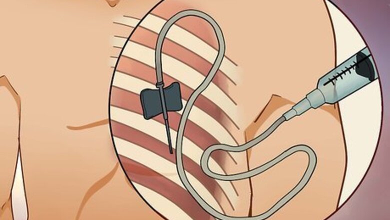 How to Treat Lung Cancer