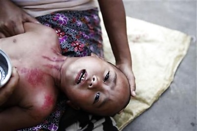 Malaria epidemic kills 51 in Tripura